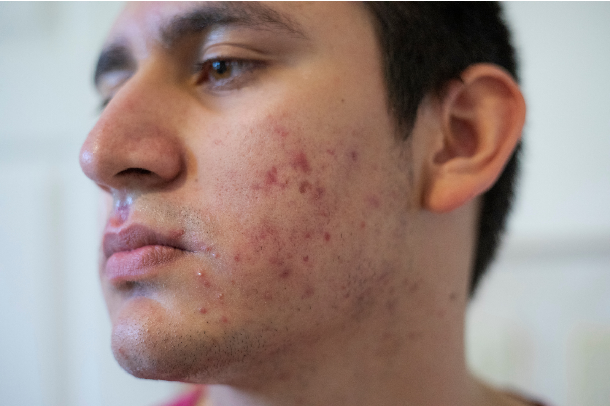 acne ayurvedic treatment